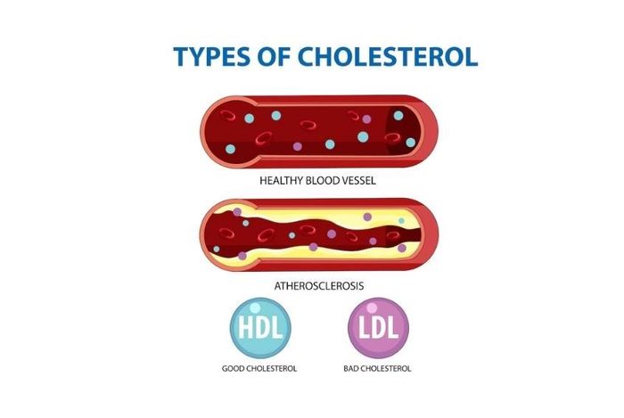 Cholesterol bao gồm hai loại: cholesterol LDL (lipoprotein có tỉ trọng thấp) và HDL (lipoprotein có tỉ trọng cao) (Ảnh: Freepik)