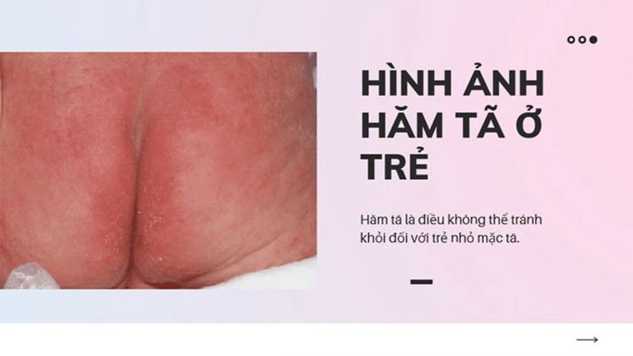 Các biểu hiện thông thường khi bé bị hăm tã