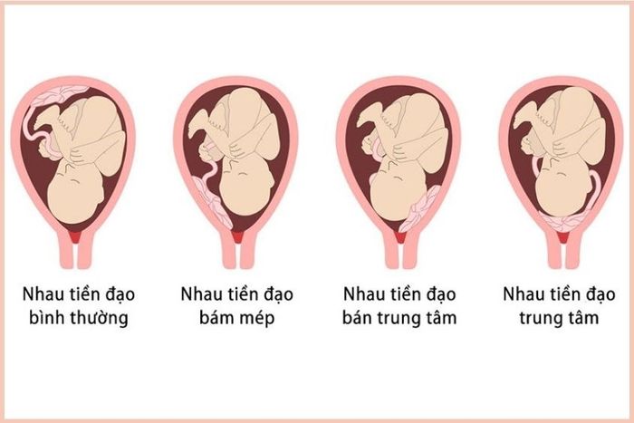 Chỉ định phẫu thuật cắt thai do vấn đề nhau tiền đạo