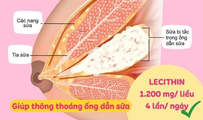 Việc sử dụng lecithin hàng ngày, 4 lần mỗi ngày, với liều lượng là 1.200 mg/ lần giúp mở thông ống dẫn sữa