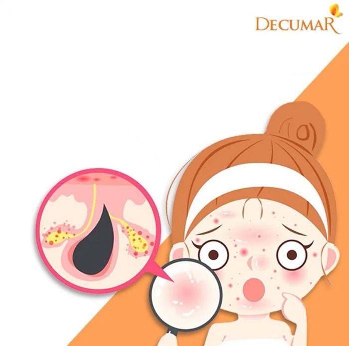 Decumar có trị được mụn đầu đen không