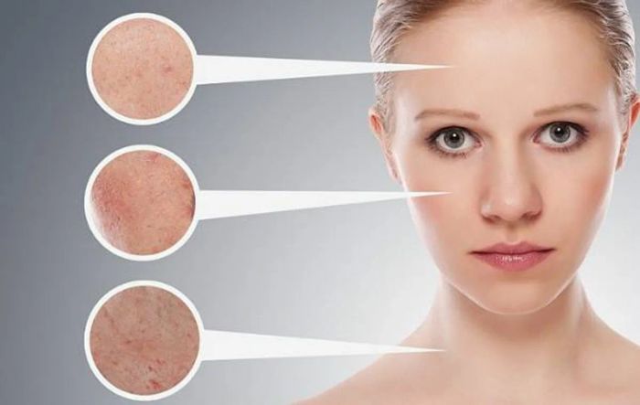 Tẩy tế bào chết BHA có hiệu quả trong việc làm sạch mụn không?