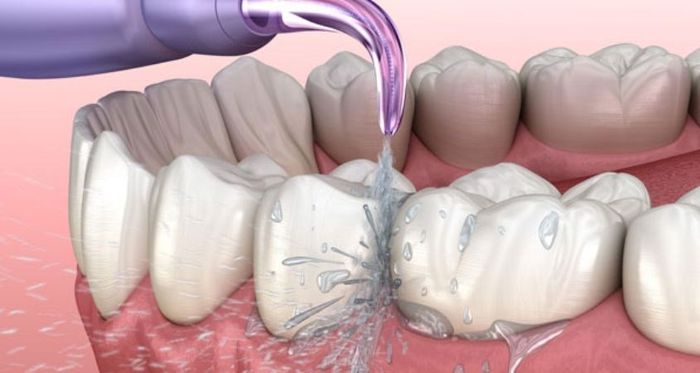 Máy tăm nước giúp làm sạch sâu bên trong hàm răng