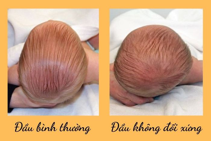 Bí quyết dân gian giúp trẻ sơ sinh khắc phục tình trạng méo đầu