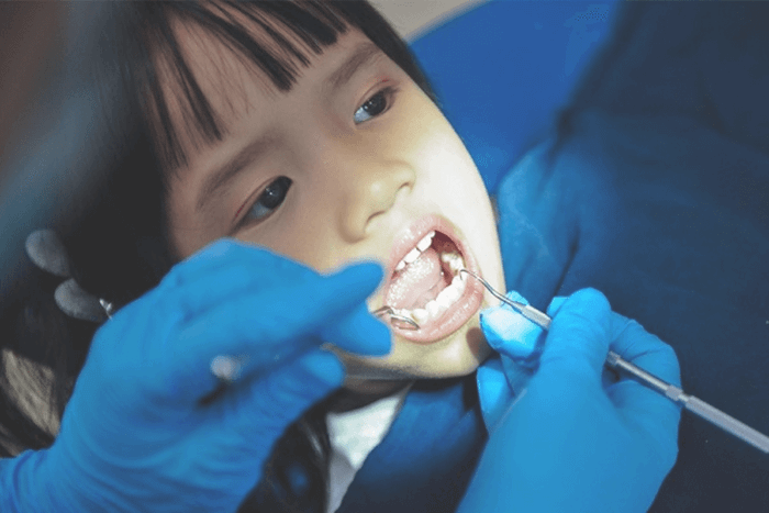 Lấy cao răng là biện pháp phòng ngừa sâu răng cho bé hiệu quả