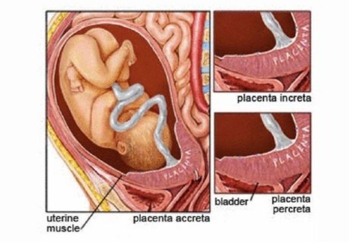 Sinh mổ nhiều lần dễ gây tổn thương cho tử cung