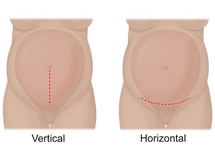 Có hai phương pháp mổ để lấy thai nhi, đó là mổ theo chiều dọc hoặc mổ theo chiều ngang