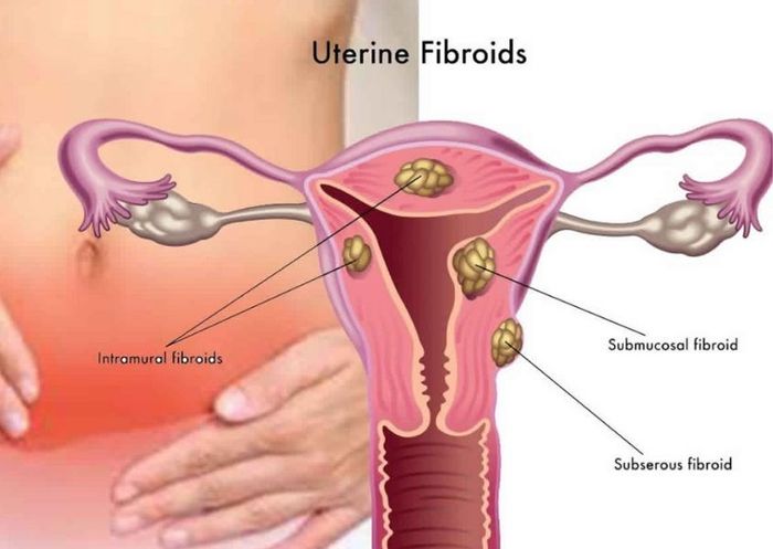 Mổ bóc u xơ tử cung trước đó rồi sinh mổ có ảnh hưởng gì không?