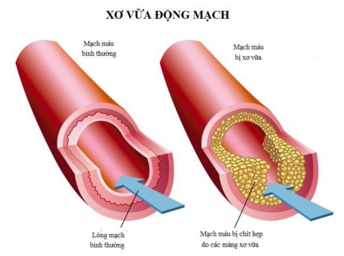 Lượng cholesterol cao có thể gây ra xơ vữa trong động mạch