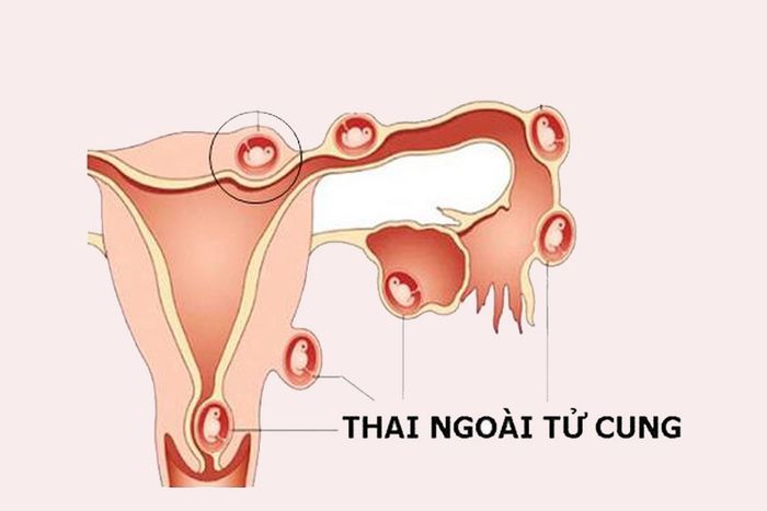 Thai có thể ẩn mình ở nhiều nơi khác ngoài tử cung