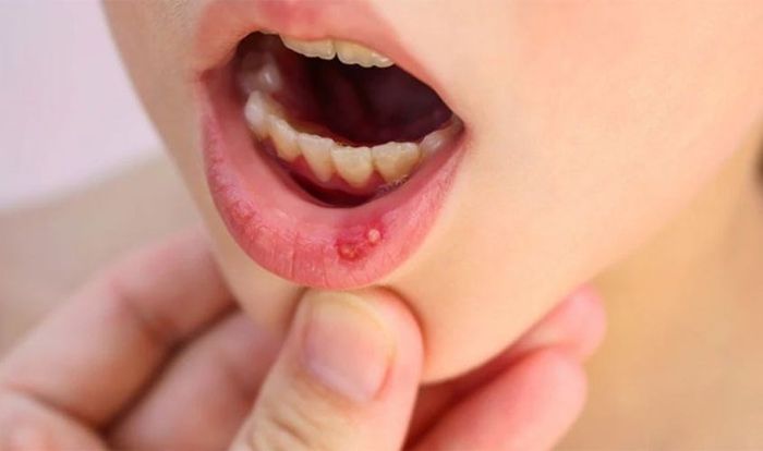 Nhiệt miệng có thể phát sinh do biến đổi nội tiết tố sau mỗi chu kỳ kinh nguyệt