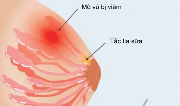 Nhiễm khuẩn gây viêm tuyến vú