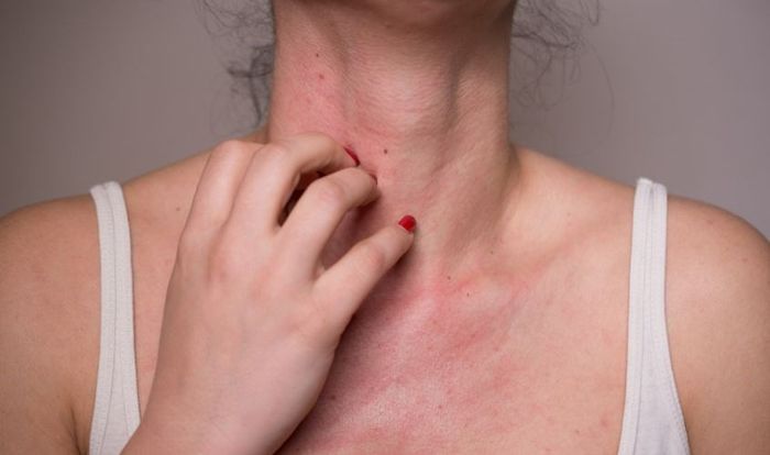 Nếu bạn dễ bị dị ứng, hãy cân nhắc trước khi sử dụng mật ong