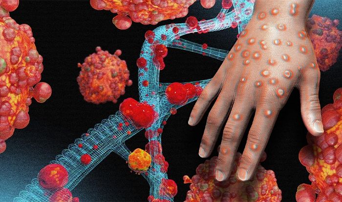 Bệnh đậu mùa khỉ do virus Orthopoxvirus gây ra