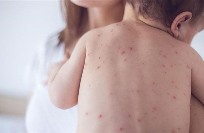 Trẻ nhỏ thường mắc bệnh đậu mùa khỉ nặng hơn so với người trưởng thành và thanh niên