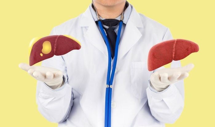 Sử dụng mật ong có thể làm nặng bệnh cho người mắc xơ gan.