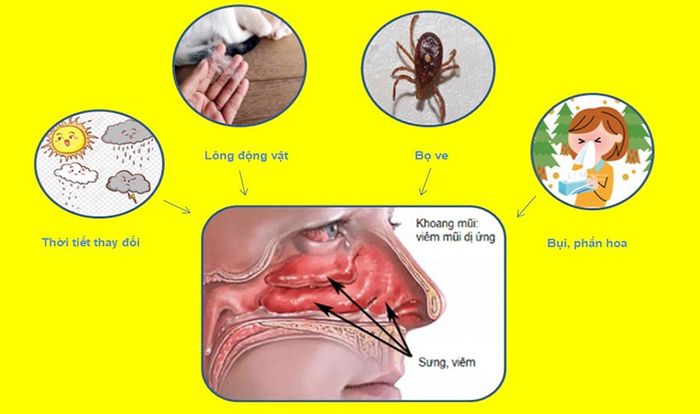 Có nhiều nguyên nhân gây viêm mũi dị ứng ở trẻ em