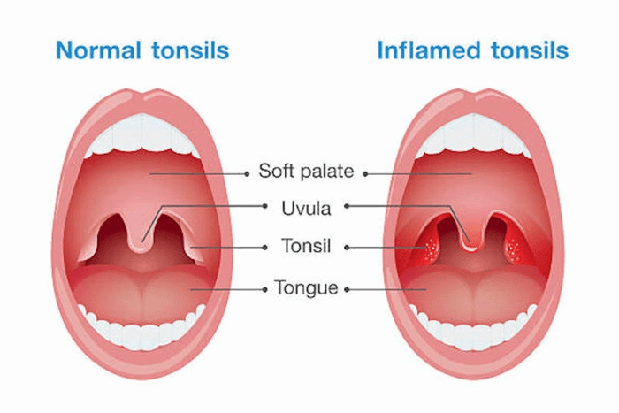Amidan sưng và đỏ