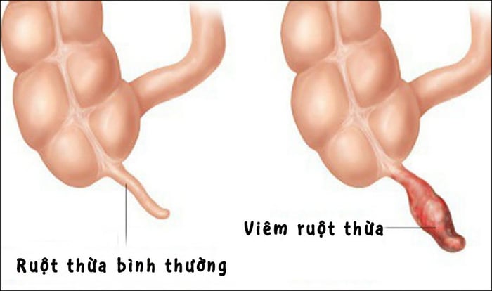 viêm ruột thừa ở trẻ nhỏ