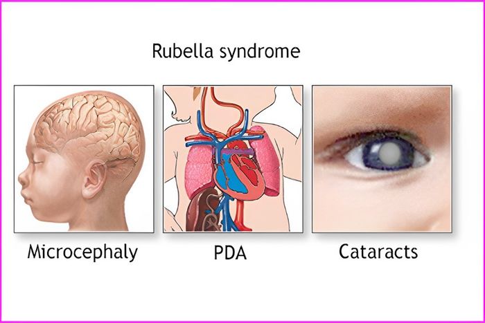 Rubella Bẩm Sinh