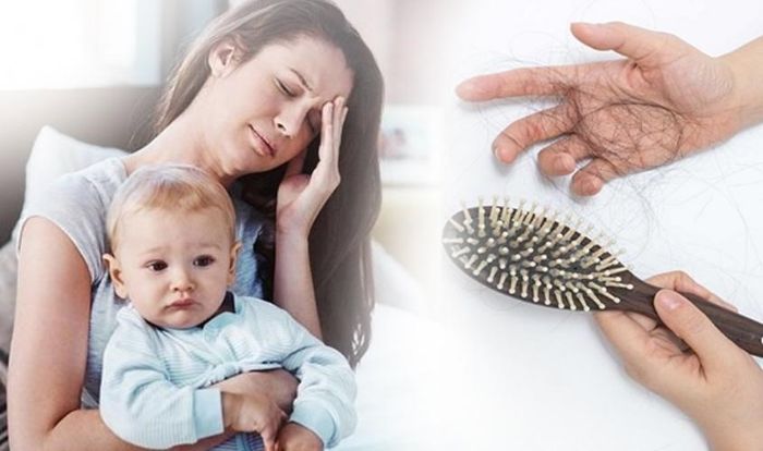 Tình trạng rụng tóc sau sinh ở phụ nữ