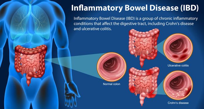 Bệnh viêm đường ruột bao gồm viêm ruột kết và bệnh Crohn