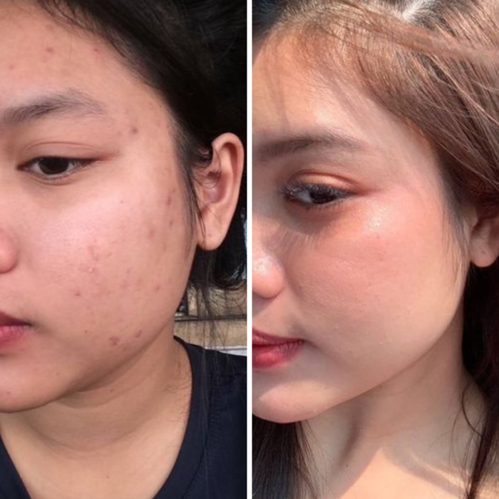 Khám phá ngay hình ảnh sau khi sử dụng bộ sản phẩm Serum và Kem Coome.