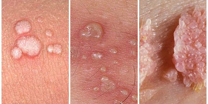 Da của người nhiễm HPV nổi mụn cóc sinh dục