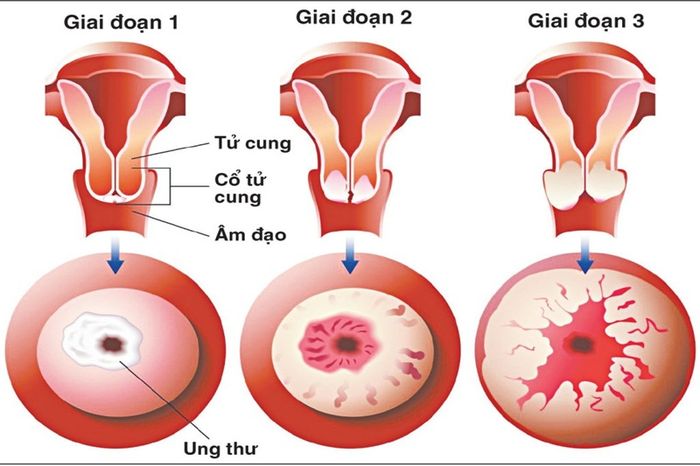 Sinh nhiều lần (trên 5 đứa con) cũng là một nguyên nhân.