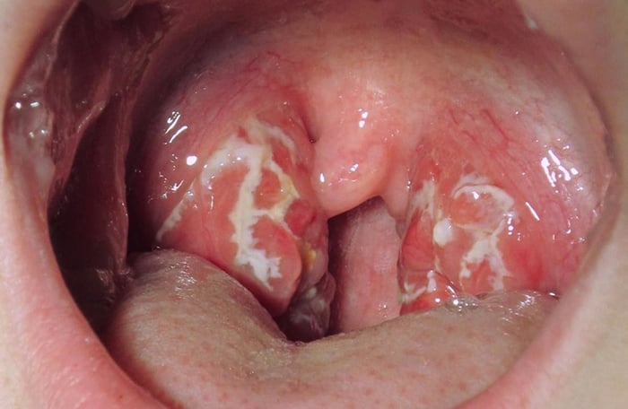 Nhiễm virus HPV có thể gây ra ung thư khoang miệng nếu không được chữa trị kịp thời.