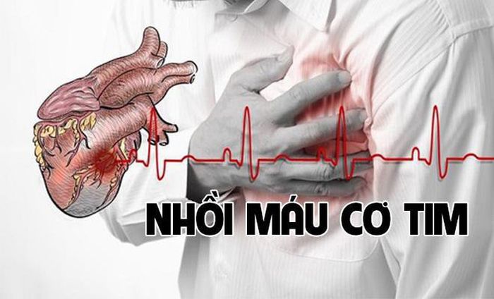 Bệnh nhồi máu cơ tim thường gây ra cơn đau lưng ở bên trái và triệu chứng khó thở