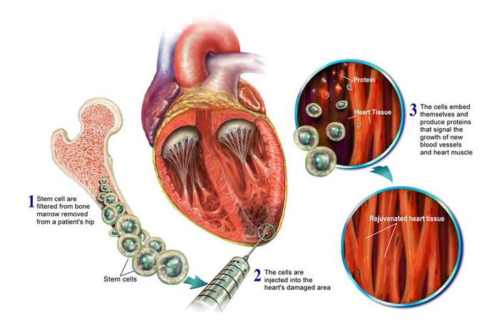 Ứng dụng công nghệ tế bào gốc trong điều trị bệnh tim