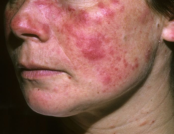 Lupus ban đỏ là bệnh gì gây ra các triệu chứng mẩn đỏ trên da mặt?