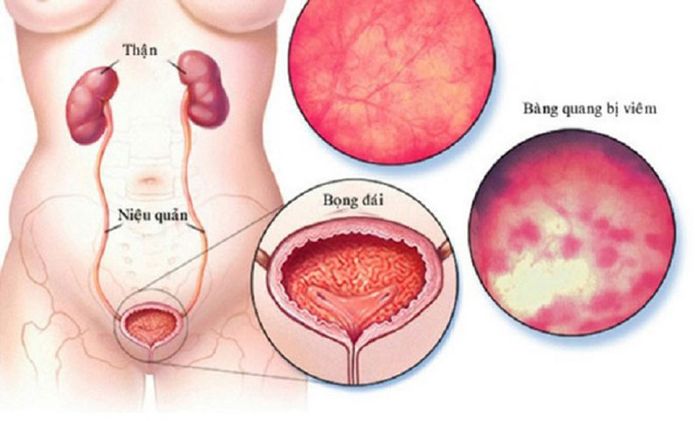 Những dấu hiệu của viêm bàng quang