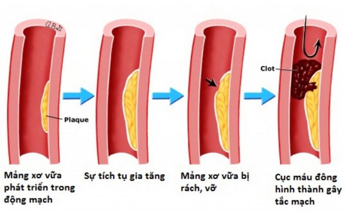 Người mắc bệnh động mạch vành thường có triệu chứng tim đập nhanh và khó thở.