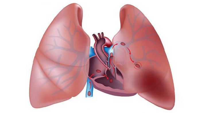 Viêm mạch máu có thể tiến triển gây ra tắc nghẽn phổi