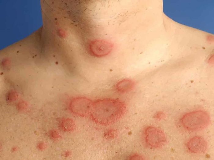 Bệnh lupus ban đỏ là một loại bệnh miễn dịch