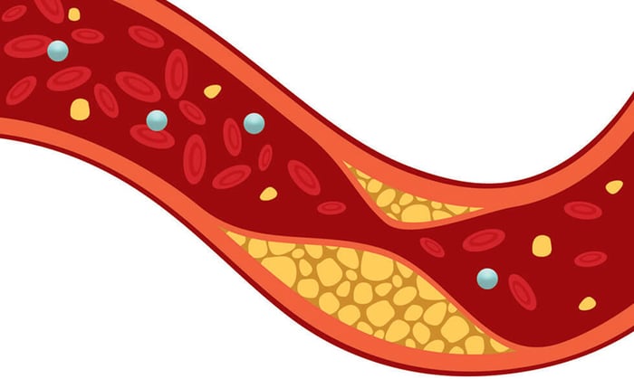 Cholesterol đóng vai trò quan trọng trong việc đánh giá mỡ máu và nguy cơ phát triển xơ vữa động mạch