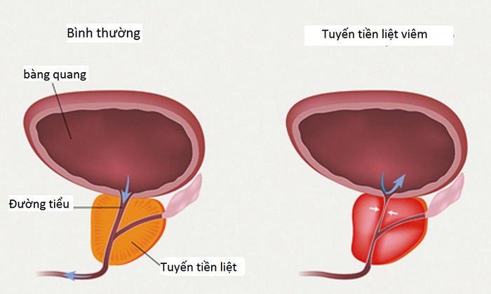 Viêm tuyến tiền liệt gây dồn nén nước tiểu và tạo áp lực dẫn đến các cơn đau vùng bụng dưới