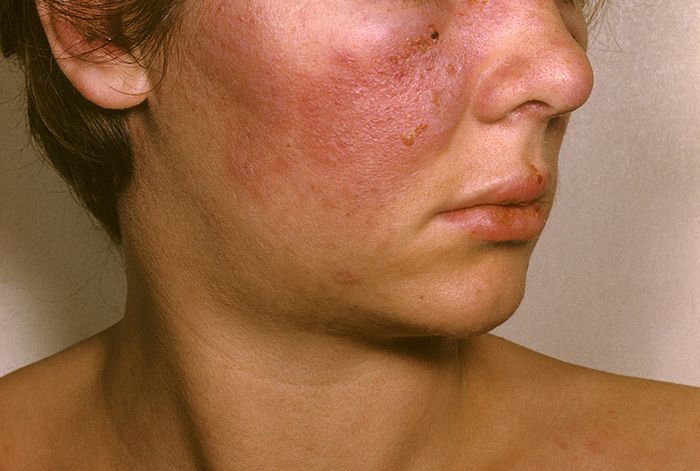 Lupus ban đỏ là bệnh nguy hiểm có thể gây tổn thương đa cơ quan khi biến chứng xảy ra