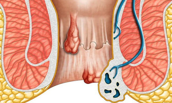 HPV cũng có thể tấn công niêm mạc và gây ung thư ở khoang miệng - họng