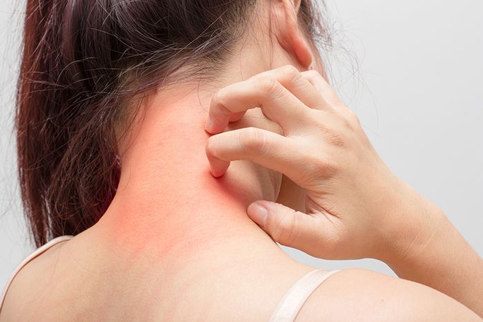 Ngứa da là một trong những dấu hiệu của bệnh gan, thường đi kèm với nổi mề đay hoặc nổi đỏ lan rộng