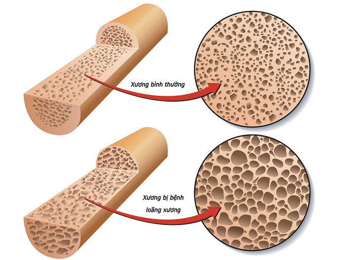 Bệnh loãng xương thường không có triệu chứng rõ ràng cho đến khi phát hiện biến chứng