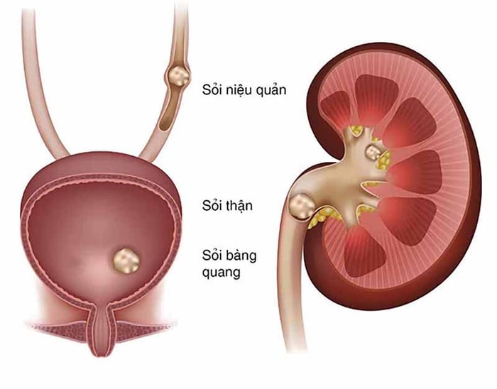 Sỏi tại hệ tiết niệu là một căn bệnh nguy hiểm, có tiến triển âm thầm, nhanh chóng và khó phát hiện