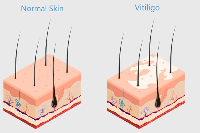 Giảm số lượng và chất lượng tế bào sắc tố da là nguyên nhân gây bệnh