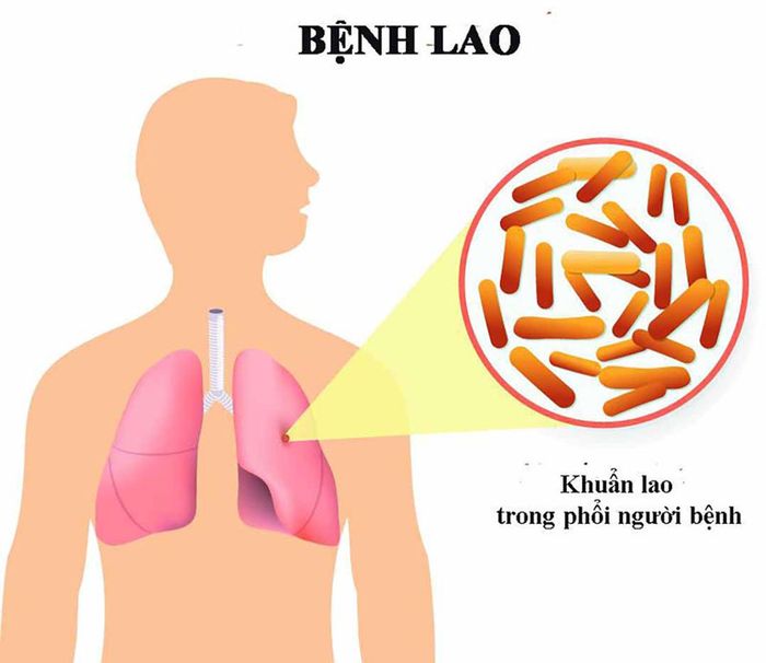 Vi khuẩn lao trong phổi của bệnh nhân có thể di chuyển tới các khớp xương