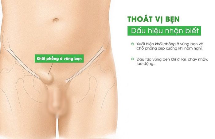 Thoát vị bẹn là tình trạng có khối phồng ở vùng bẹn