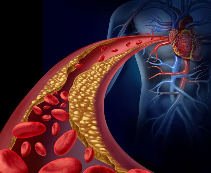 Rối loạn lipid máu có thể gây ra hậu quả nghiêm trọng, thậm chí đe dọa tính mạng bệnh nhân