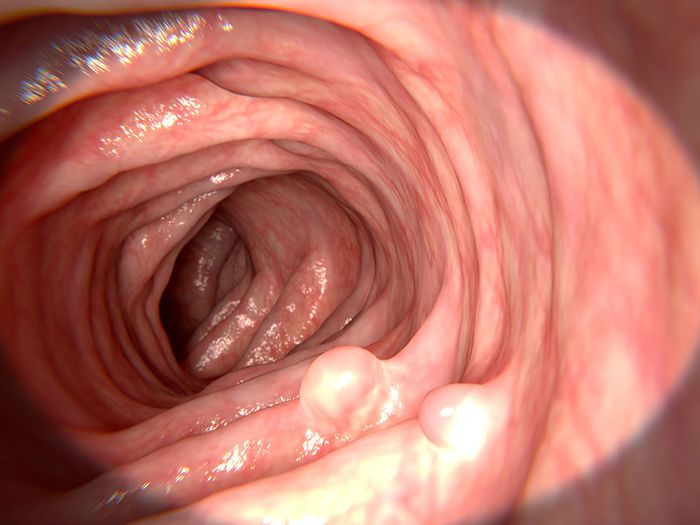 Polyp thực quản là hiện tượng các tế bào biểu mô phát triển không kiểm soát và thường mang tính chất lành tính