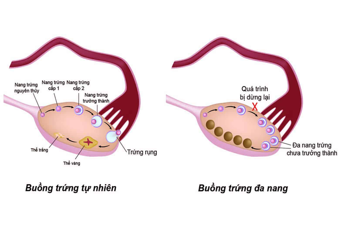 Phụ nữ mắc hội chứng đa nang dễ bị rụng tóc